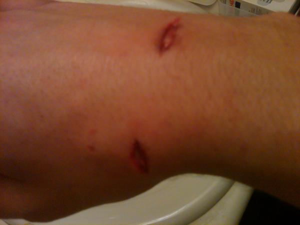 Dog bite