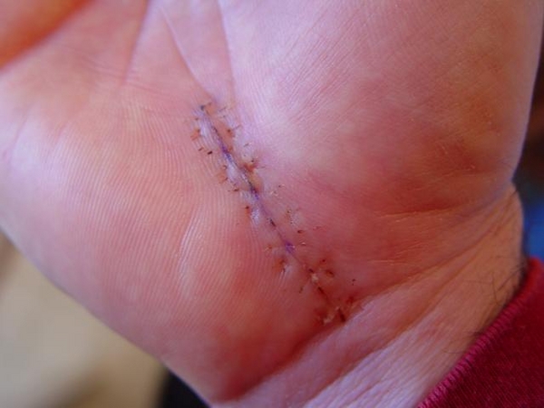 Owmyhandhurts