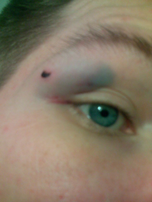 blackeye