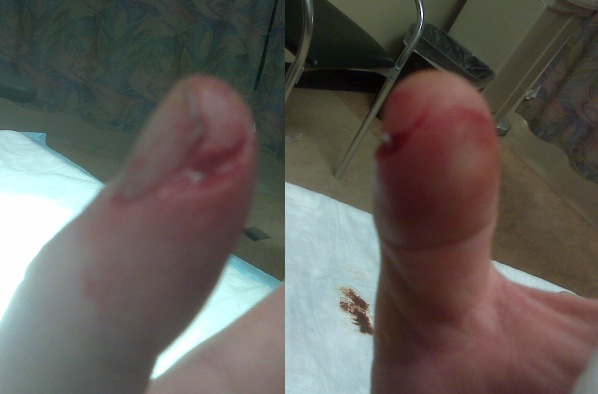 thumb