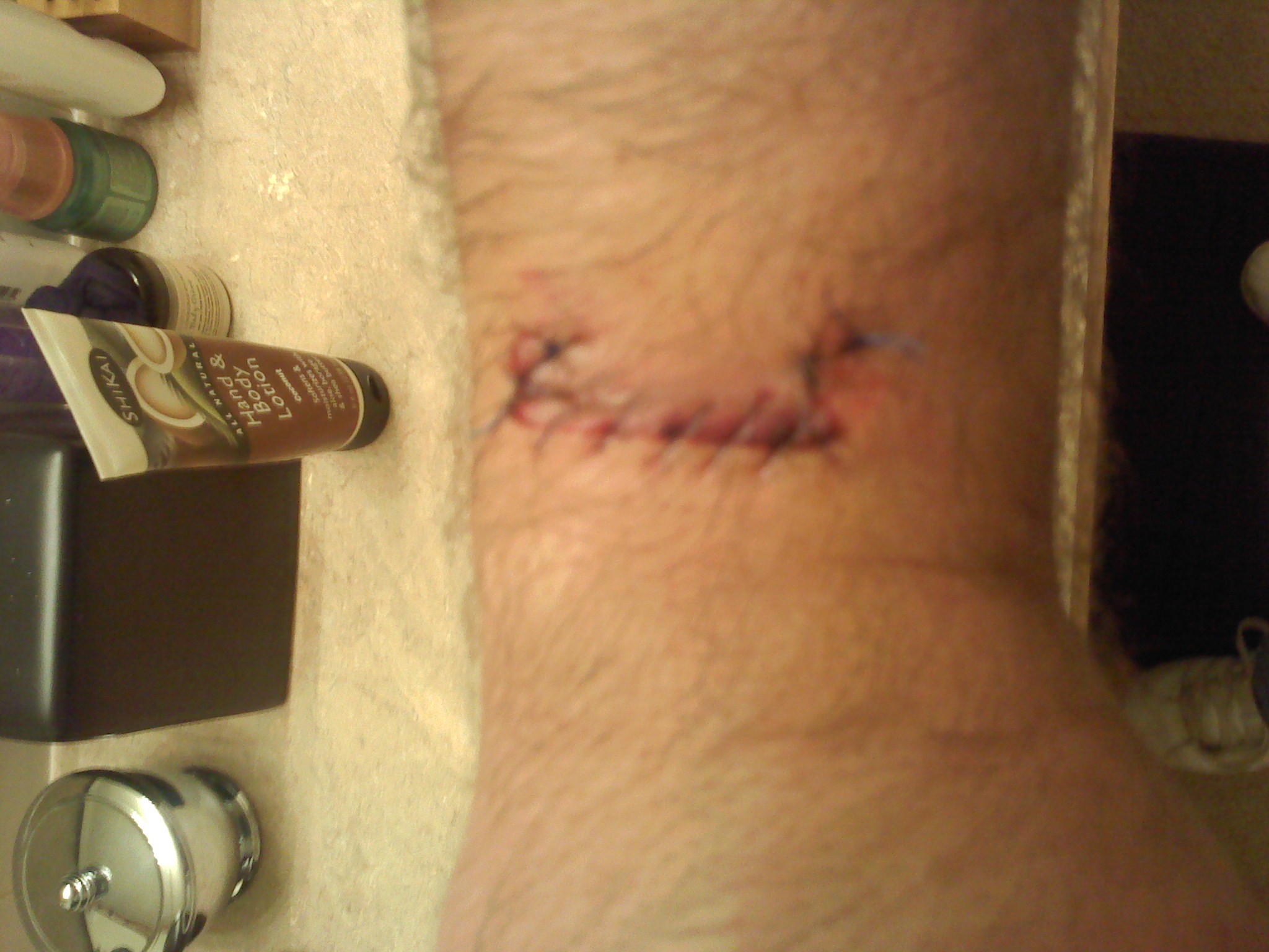 wound