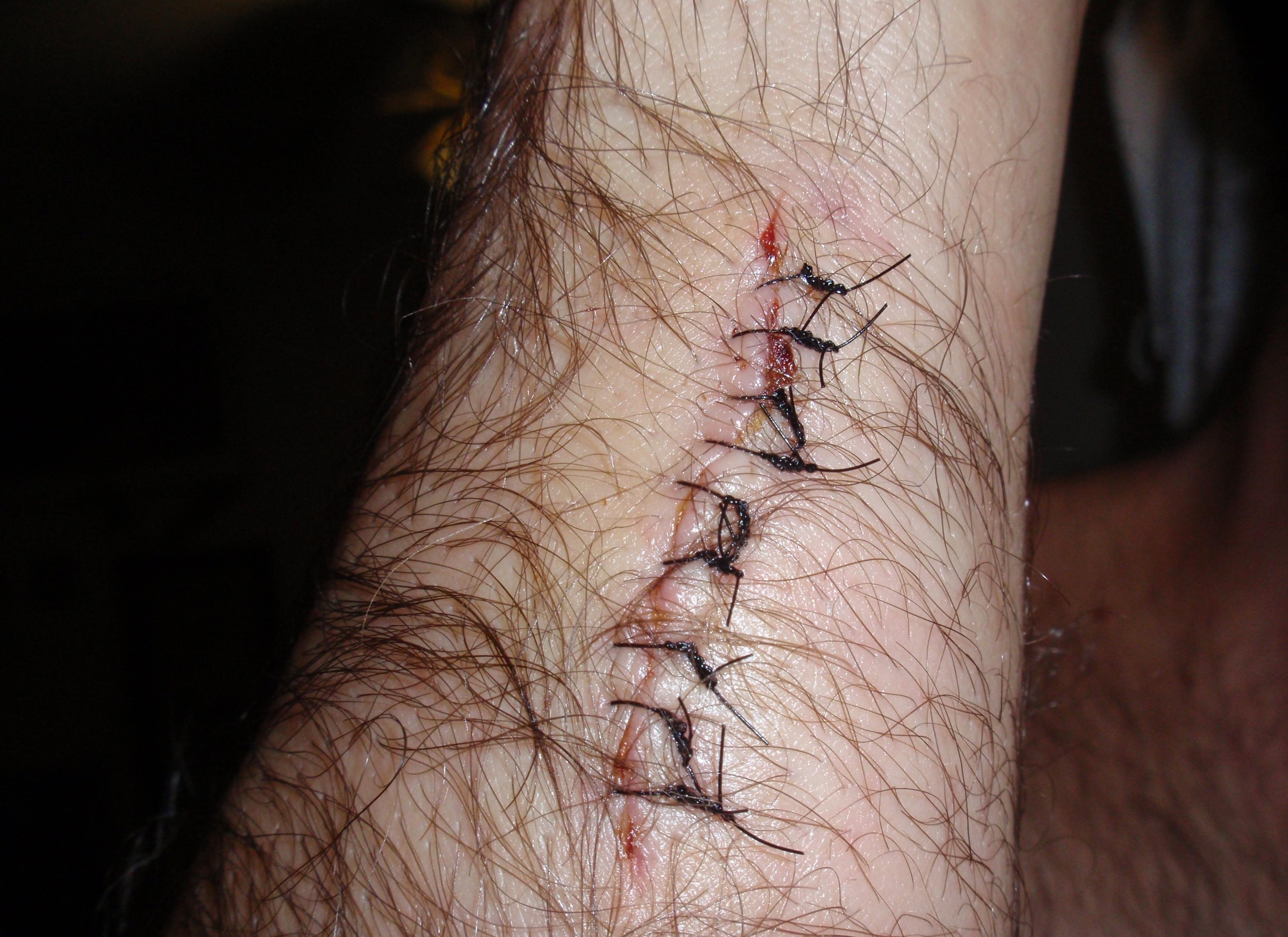 arm stitches