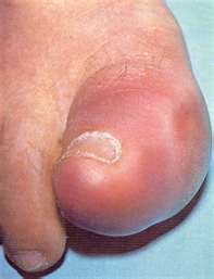 symptoms-of-gout-in-the-toe.jpeg