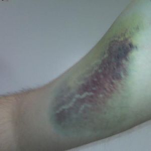 Arm