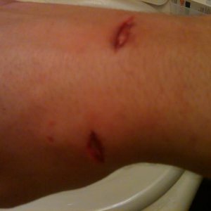Dog bite