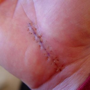 Owmyhandhurts