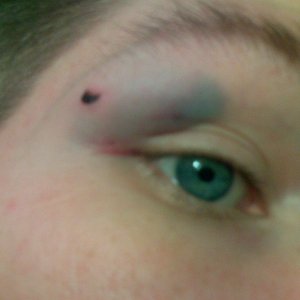 blackeye