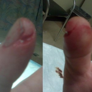 thumb