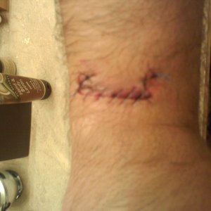wound