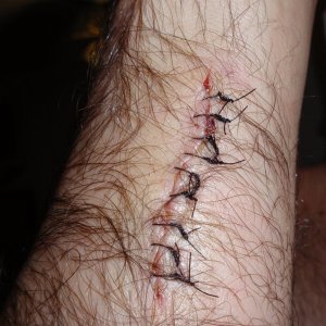 arm stitches