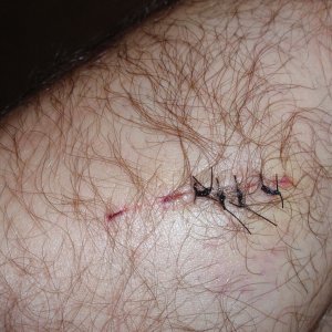 arm stitches